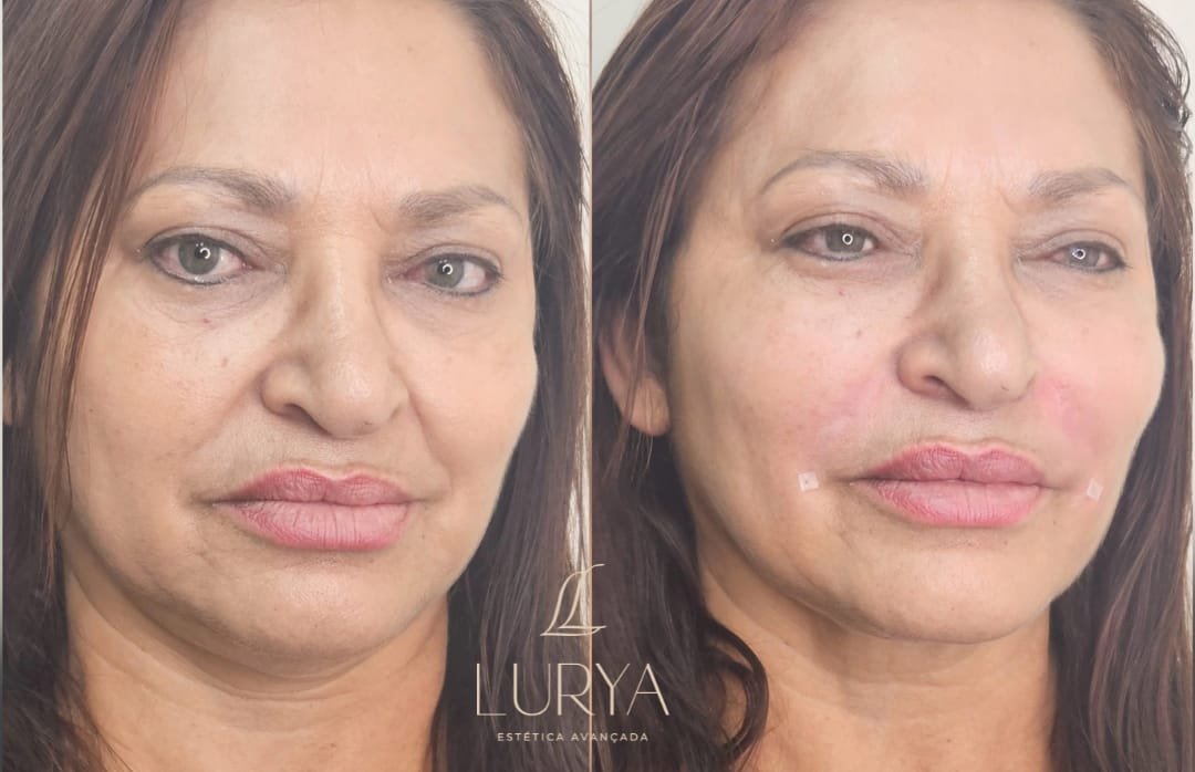 Preenchimento Bigode chinês antes e depois